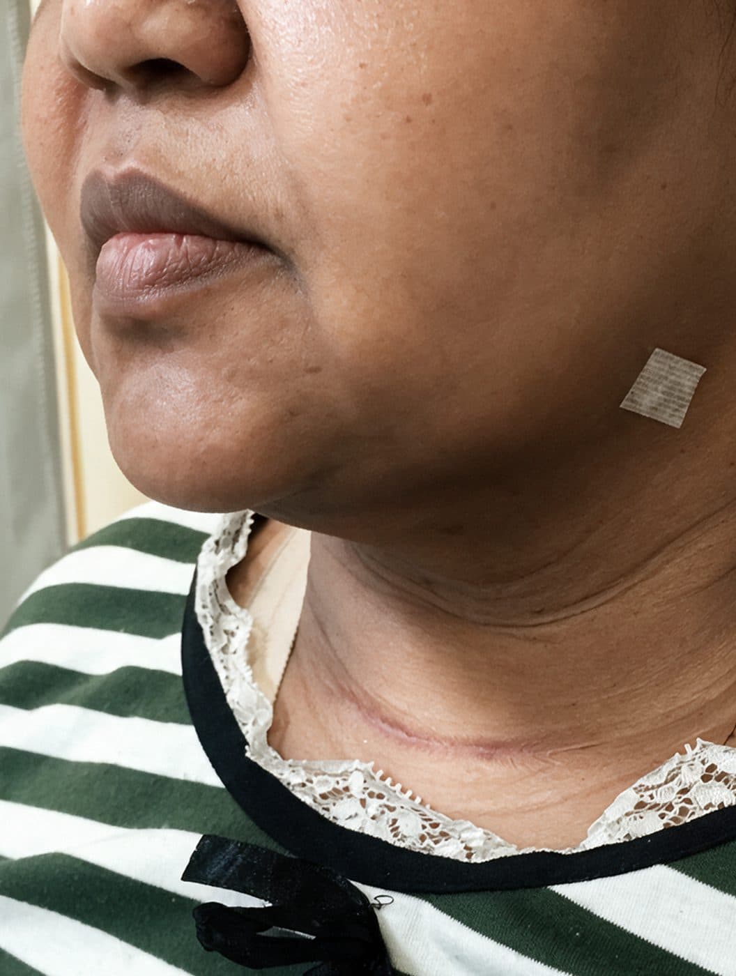Double Chin Treatment — After