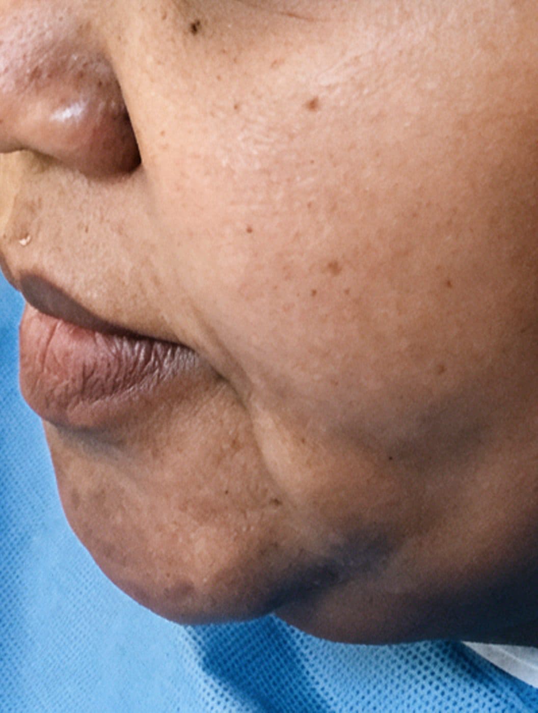 Double Chin Treatment — Before