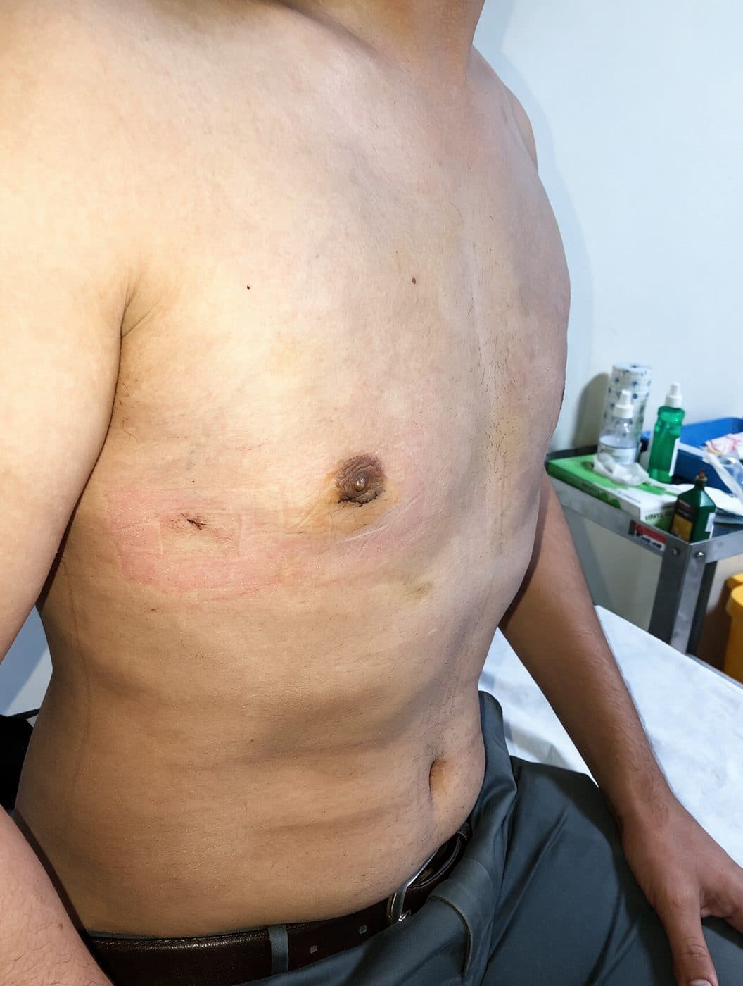 Gynecomastia — After