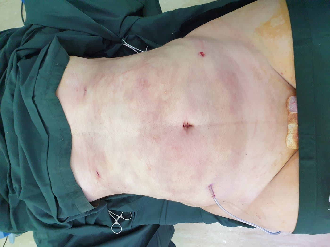 Liposuction — After