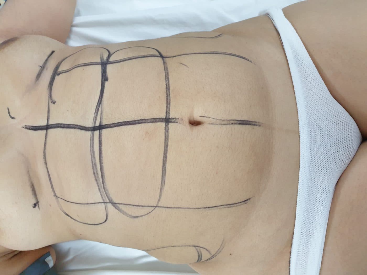 Liposuction — Before