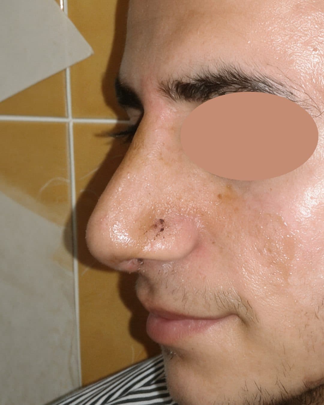 Rhinoplasty — After