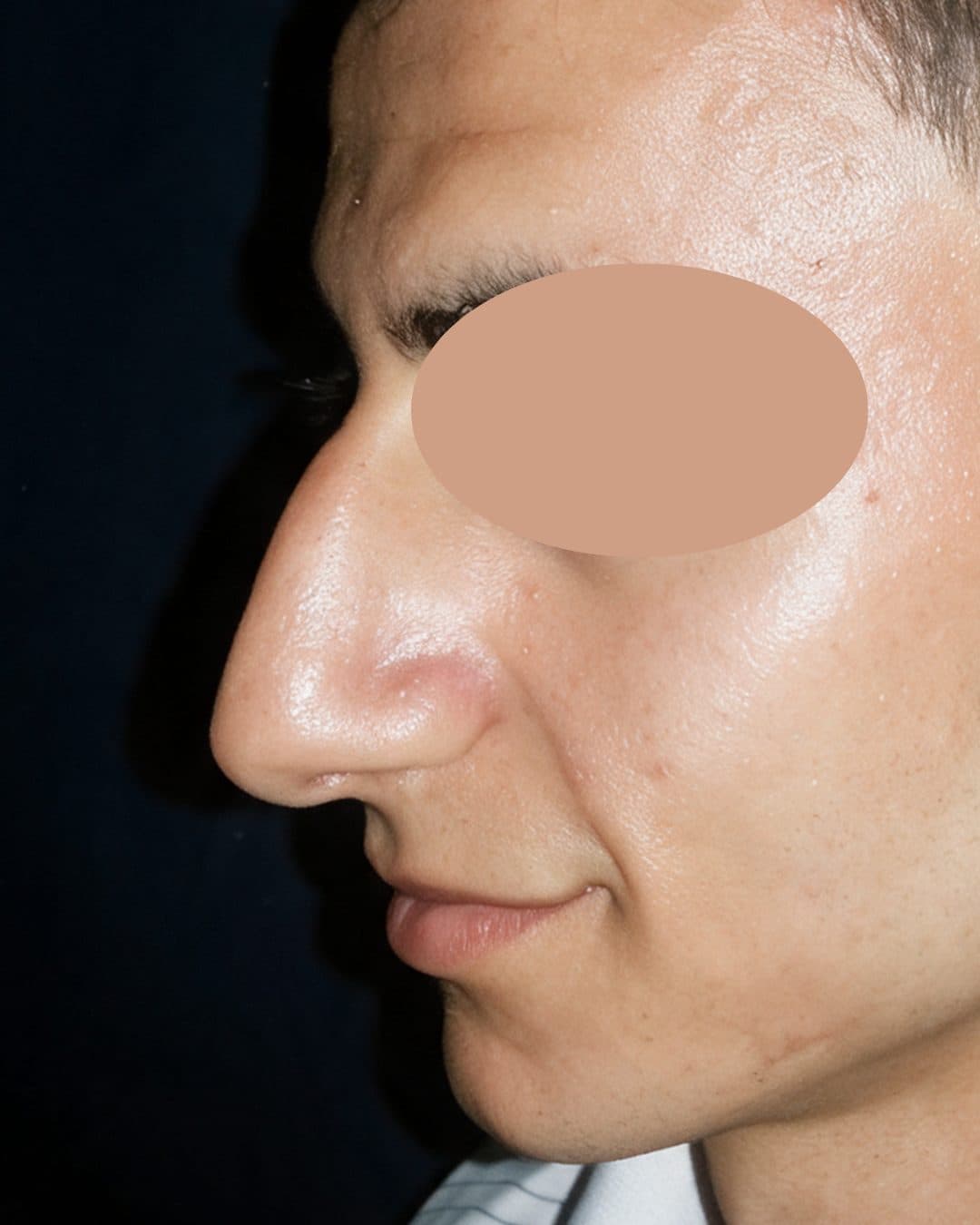 Rhinoplasty — Before